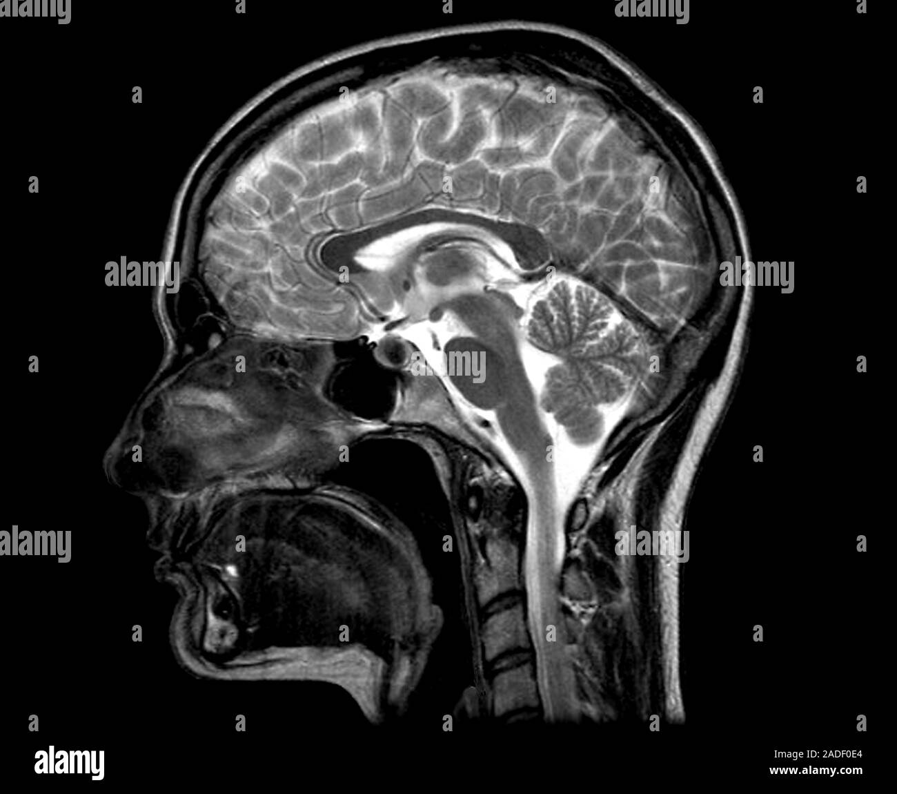 Human head and brain. Magnetic resonance imaging (MRI) scan of a ...