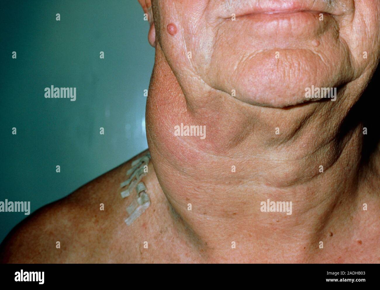 Lymphoma Clinical Photo Of The Neck Of A Patient With A Non Hodgkins