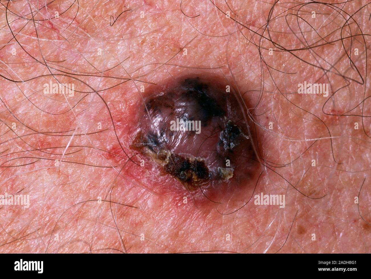 Skin Cancer Pigmented Basal Cell Carcinoma Bcc Or Rodent Ulcer On