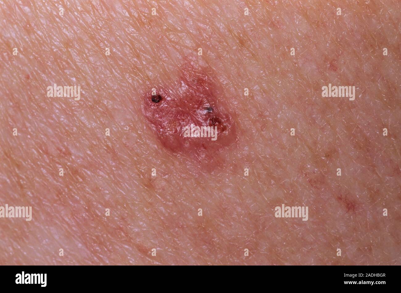 Skin Cancer Basal Cell Carcinoma Bcc Or Rodent Ulcer On The Skin