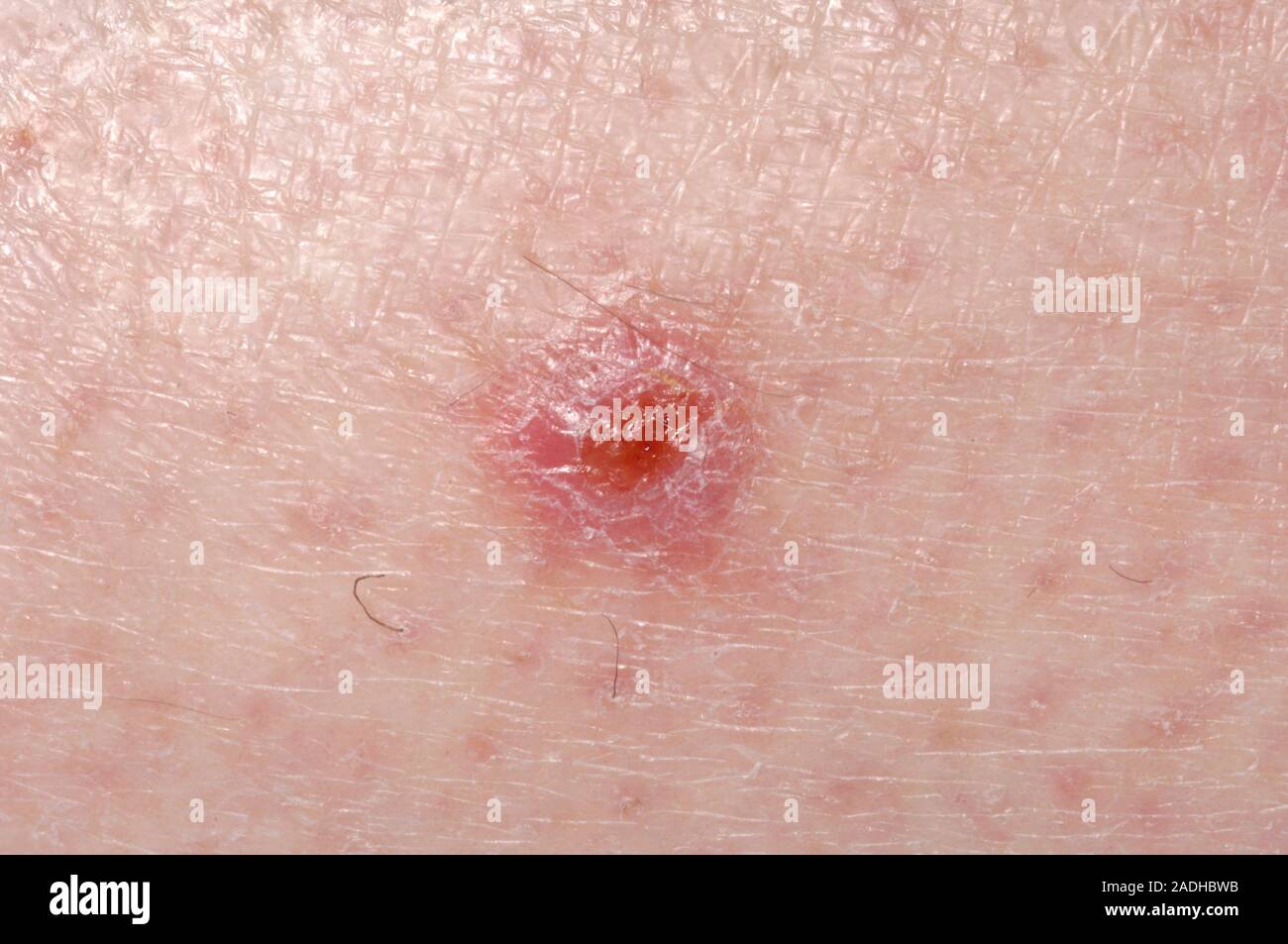 Skin Cancer Ulcerated Basal Cell Carcinoma On A 71 Year Old Womans