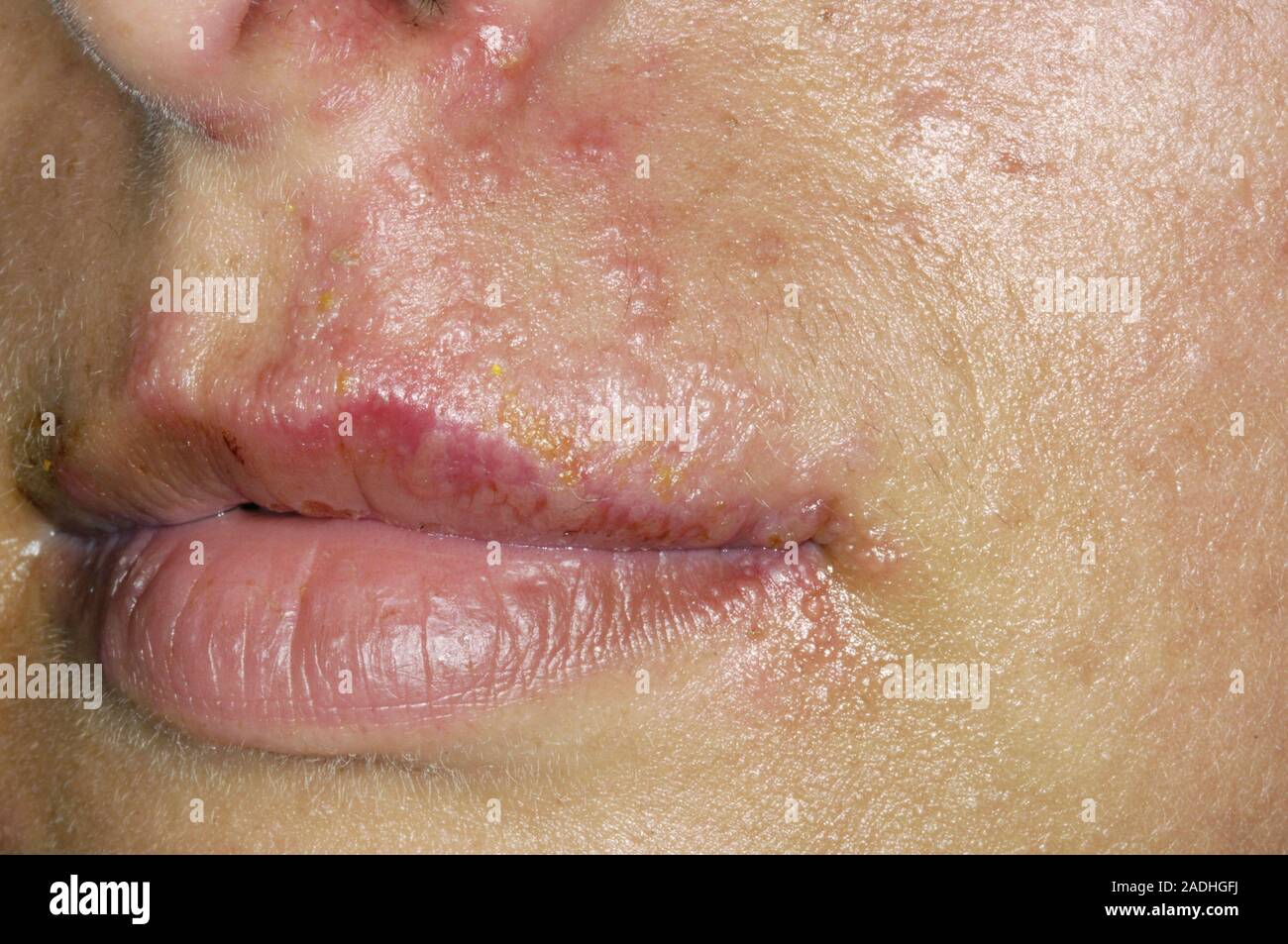 Cold Sores On The Upper Lip Of A 28 Year Old Woman Cold Sores Are