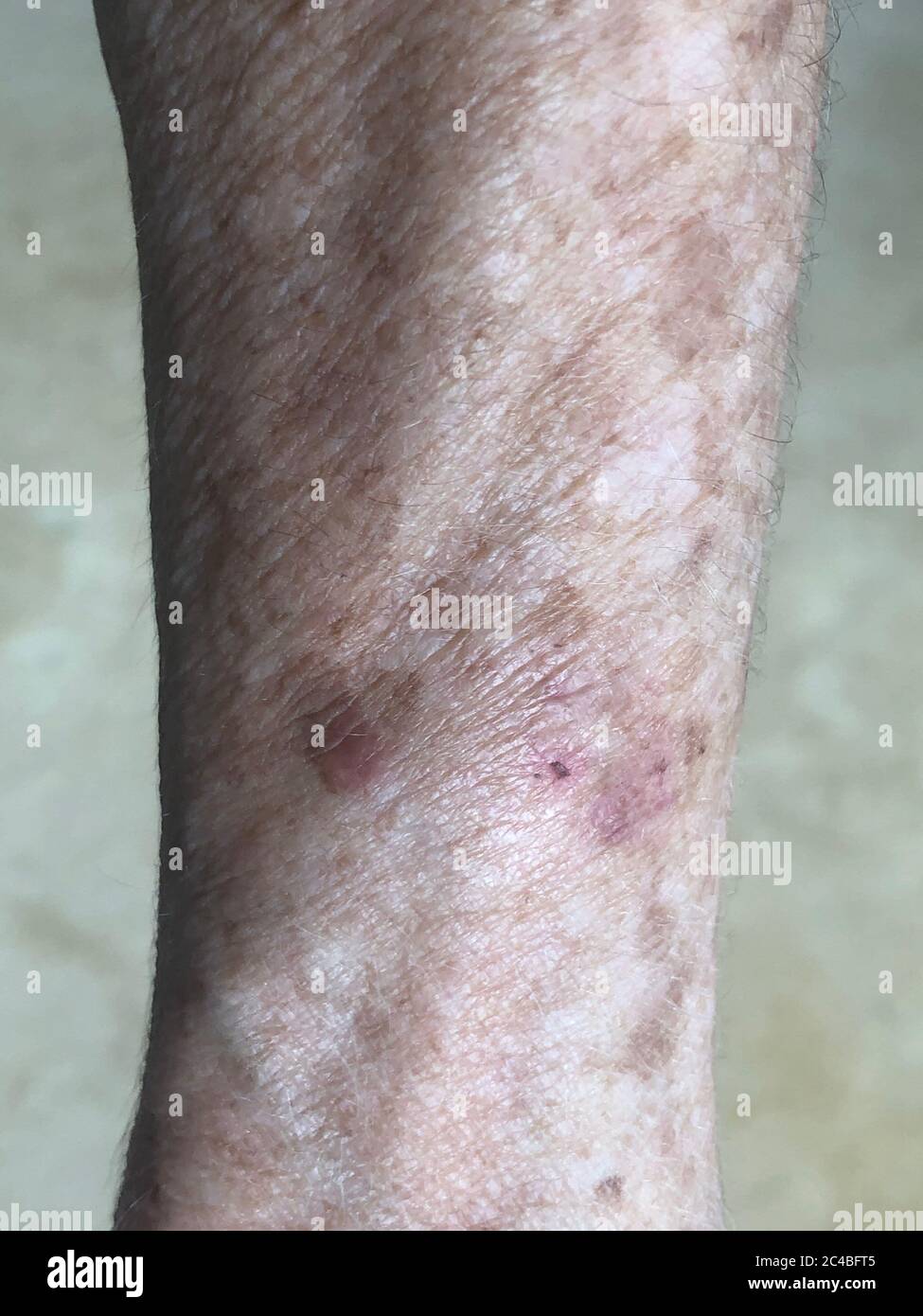 Age Spots On The Forearm Of A 72 Year Old Woman Stock Photo Alamy