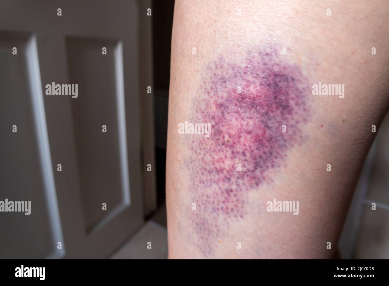 Terrible Bruise On The Upper Leg Of A Woman Stock Photo Alamy