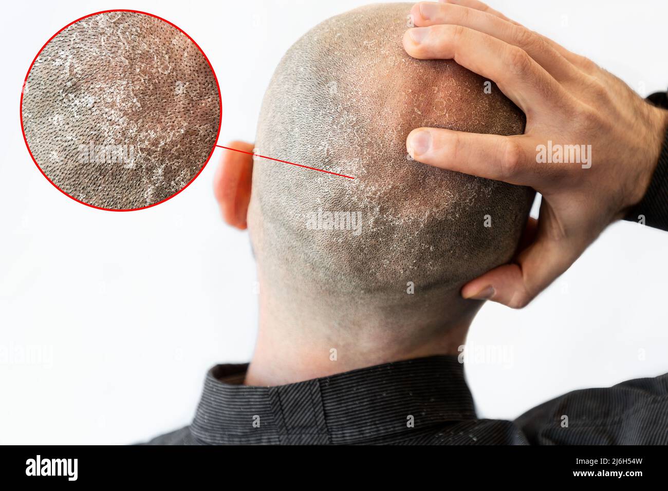 A Man In A Black Shirt Is Holding His Bald Flaky Head Covered With Seborrheic Dermatitis And
