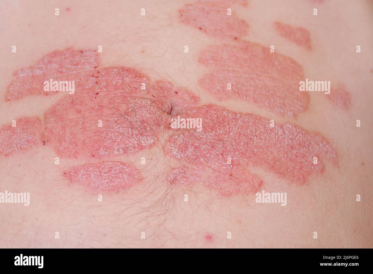 Large Red Inflamed Scaly Rash On The Stomachacute Psoriasis On The