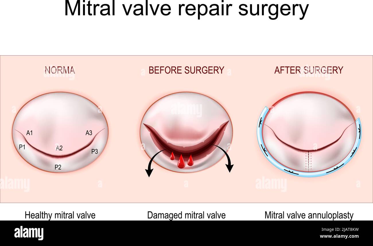 Mitral Valve Repair Surgery Healthy Mitral Valve Damaged Mitral Valve