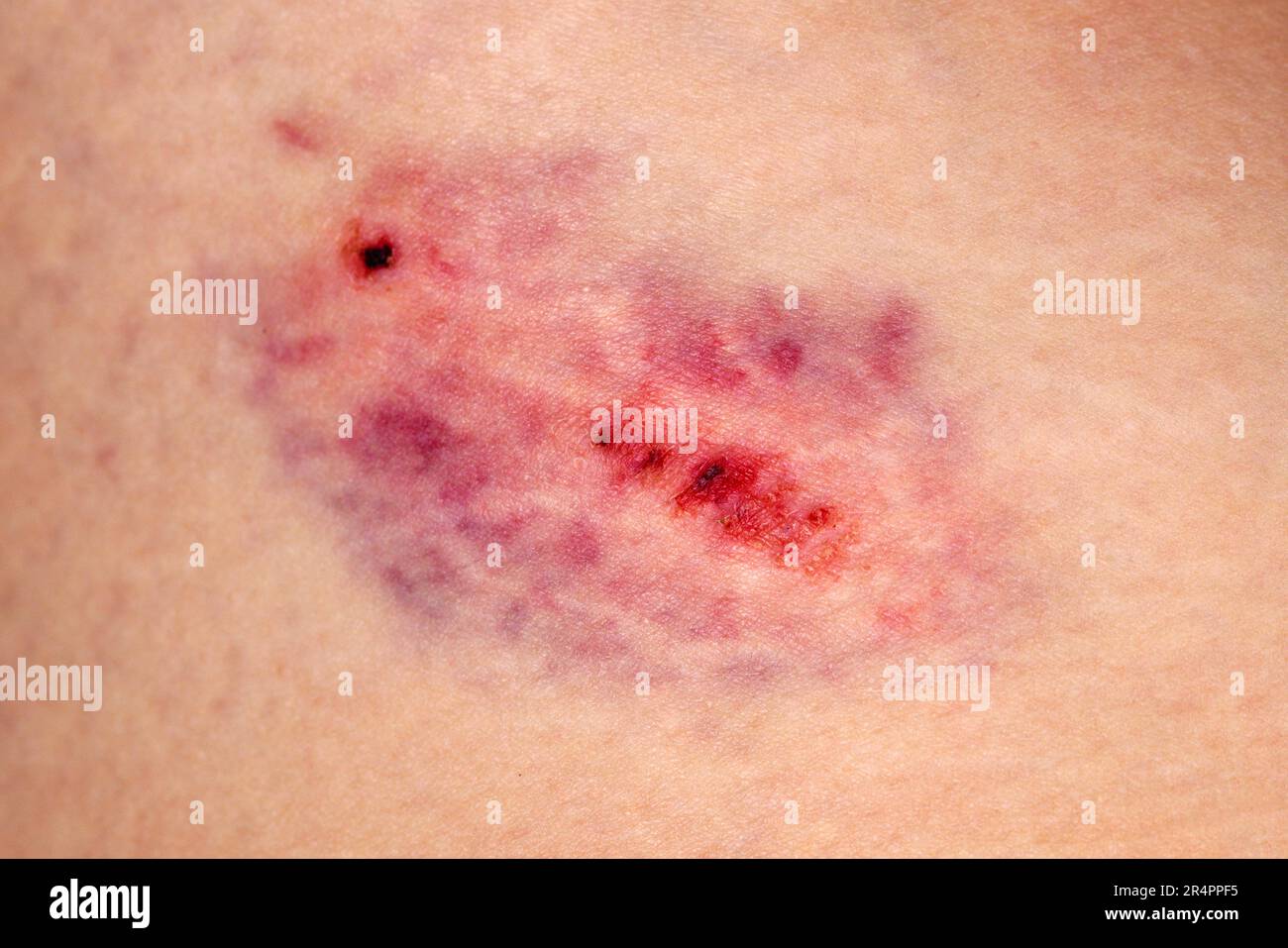 Closeup Bruise On Wounded Woman Leg Skin Domestic Violence Stock Photo
