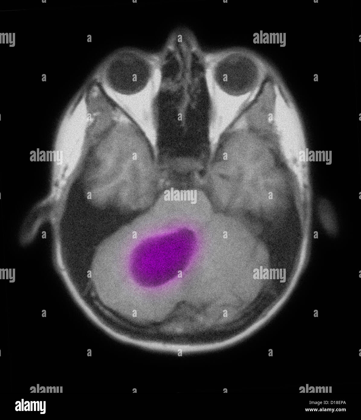 Mri Of The Brain Showing An Astrocytoma Tumor Stock Photo Alamy