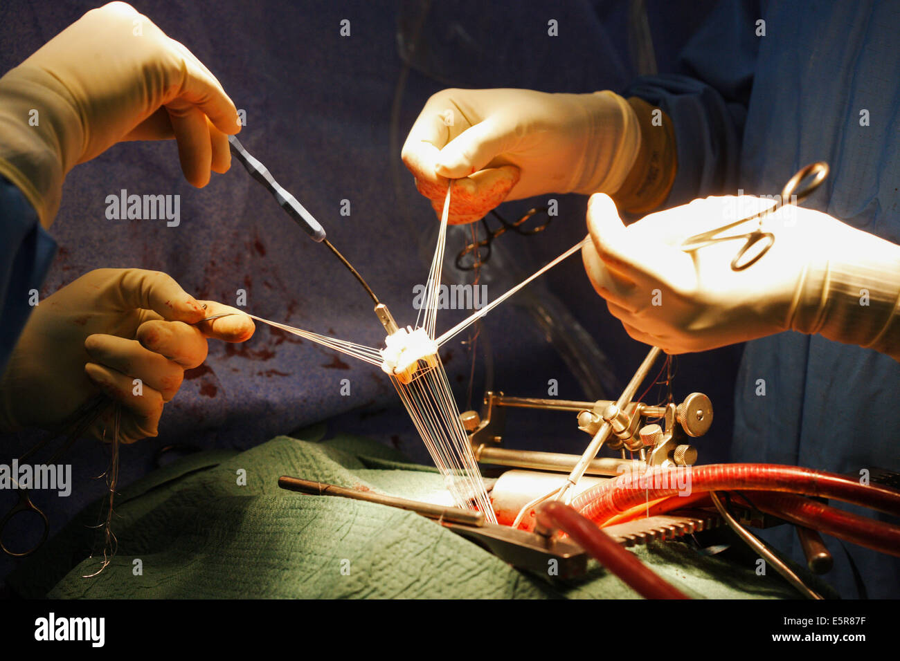 Mitral Valve Replacement Surgery An Open Heart Surgery Requiring A