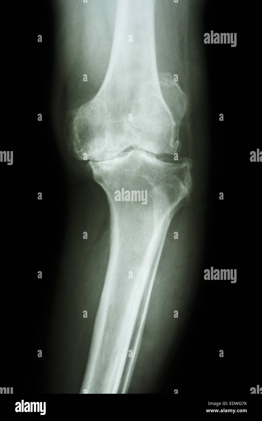 film x-ray knee AP of osteoarthritis knee patient (OA knee Stock Photo ...