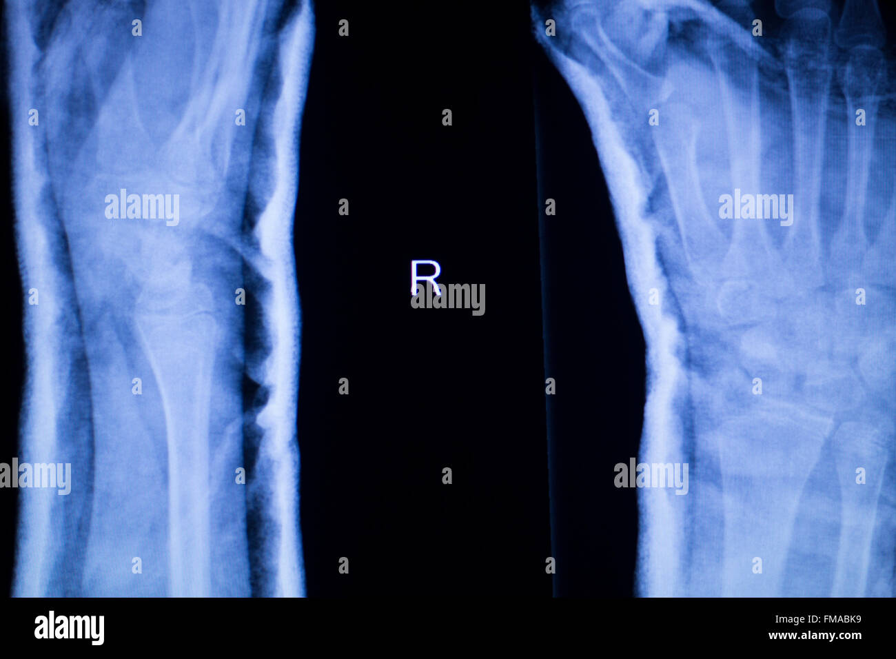Forearm Arm And Elbow Injury Xray Scan Test Reults To Diagnose Pain