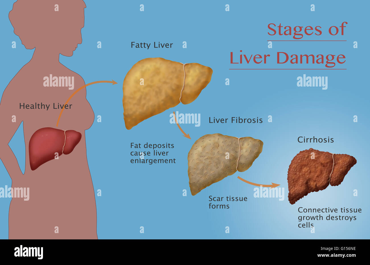 Stages of liver damage due to alcoholism. First alcohol compromises the ...