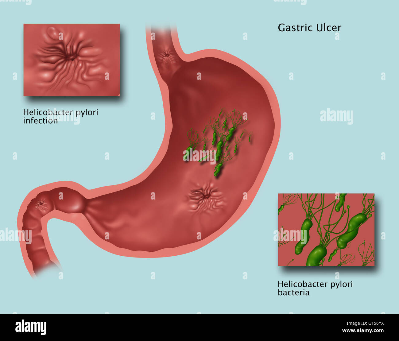 Illustration Showing The Stomach With A Gastric Ulcer Caused By
