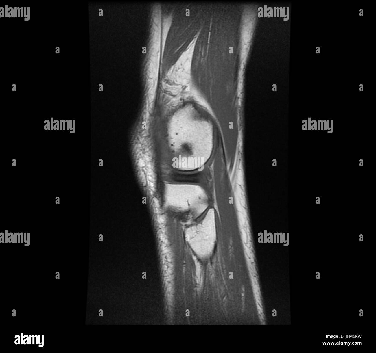 Negative X ray image of human Knee Rheumatism Stock Photo - Alamy