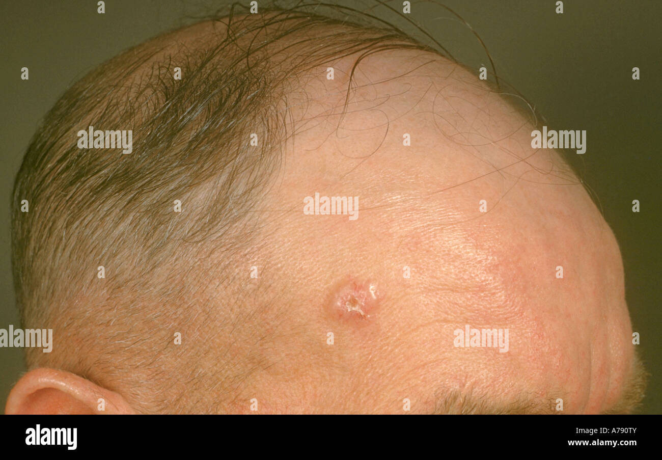 Rodent Ulcer On Forehead Stock Photo Alamy
