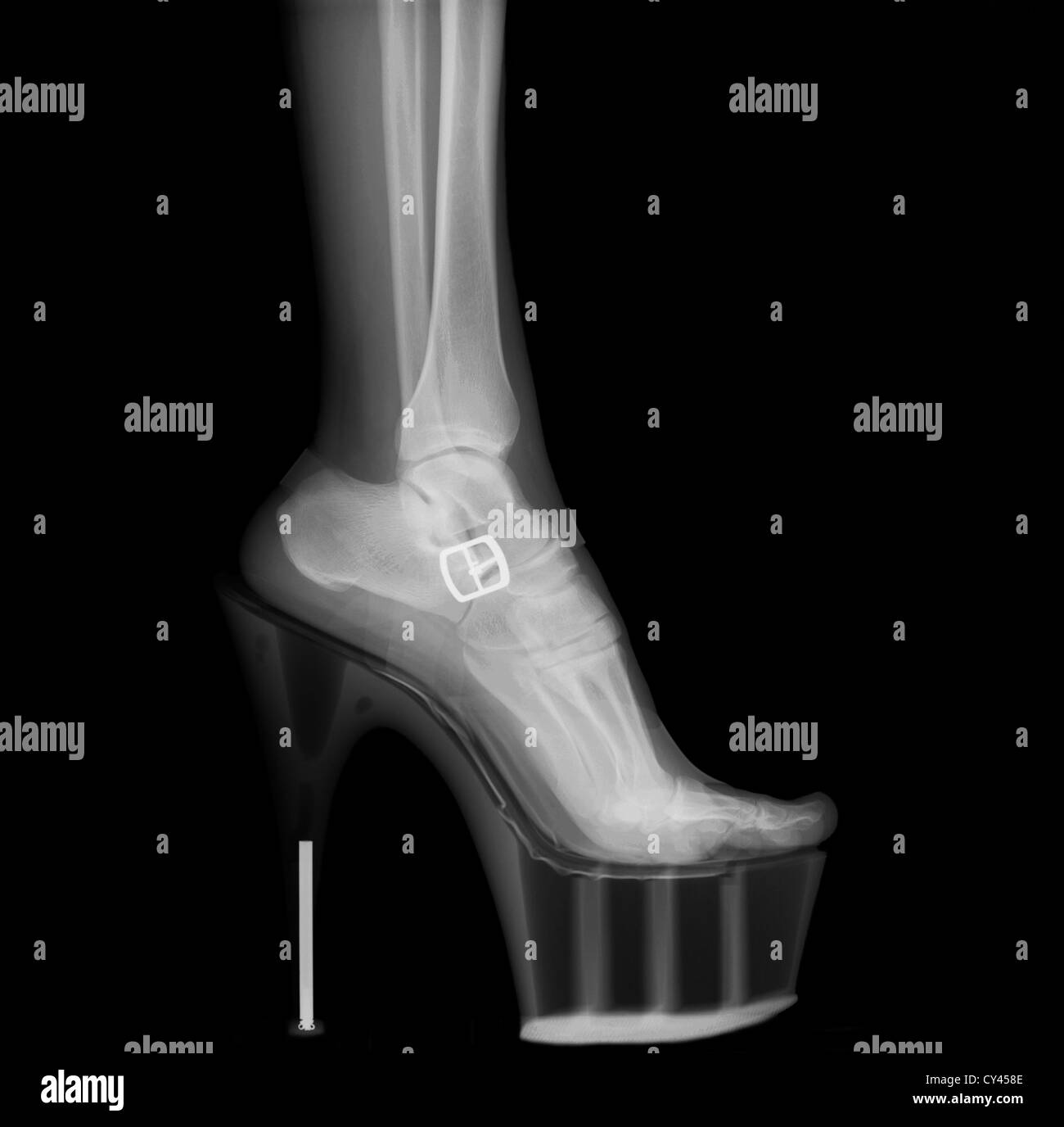 Xray of a woman leg wearing Stiletto HighHeeled Shoe Stock Photo Alamy