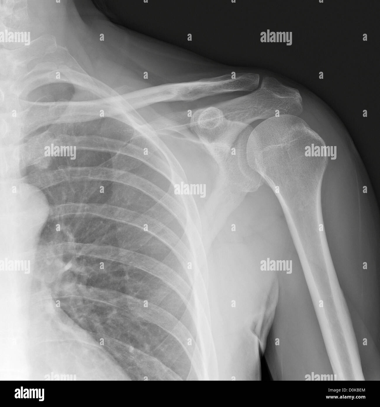 An x-ray human shoulder front showing humerus (the upper arm bone