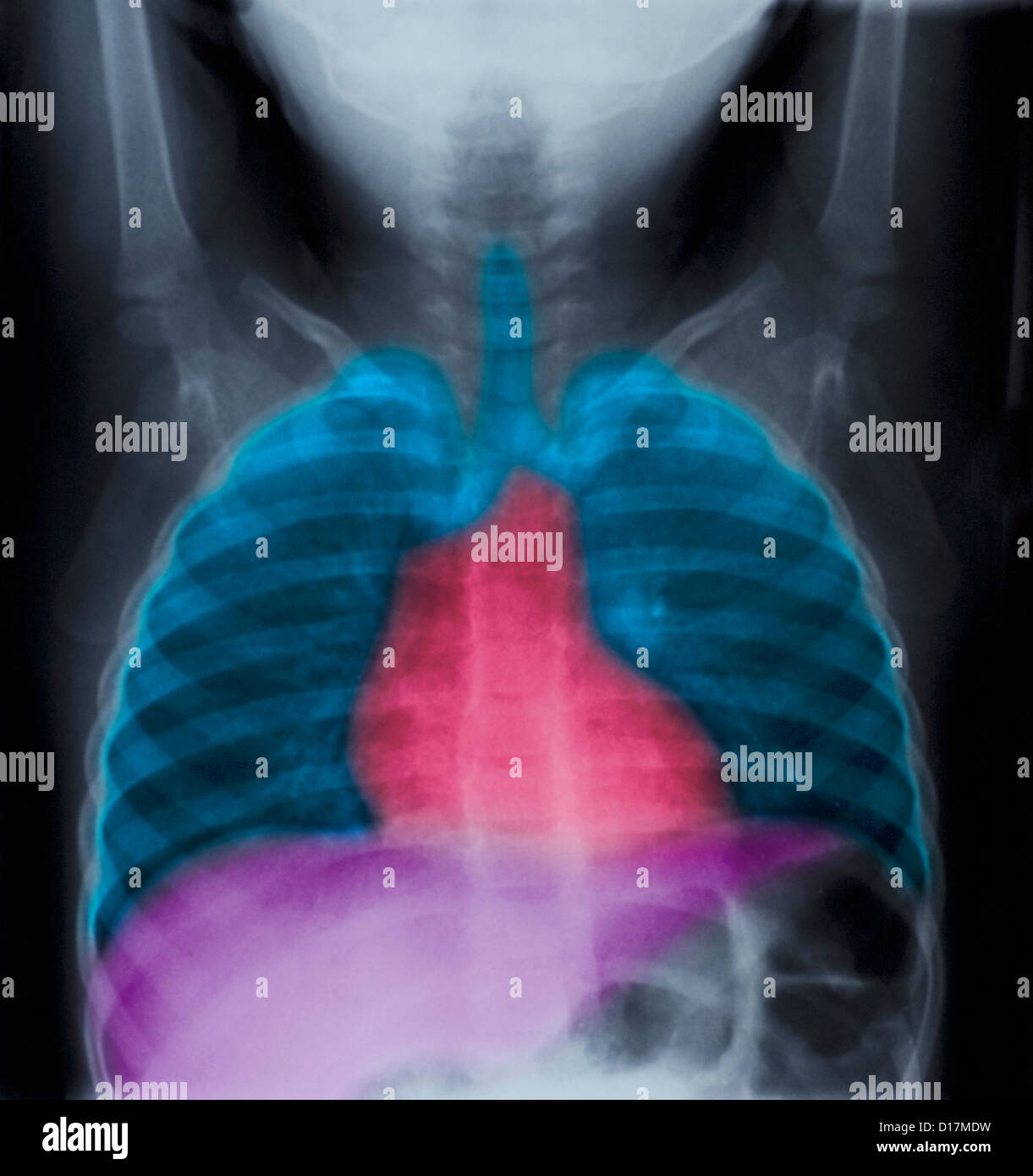 Normal chest X-ray of a 2 year old girl Stock Photo - Alamy