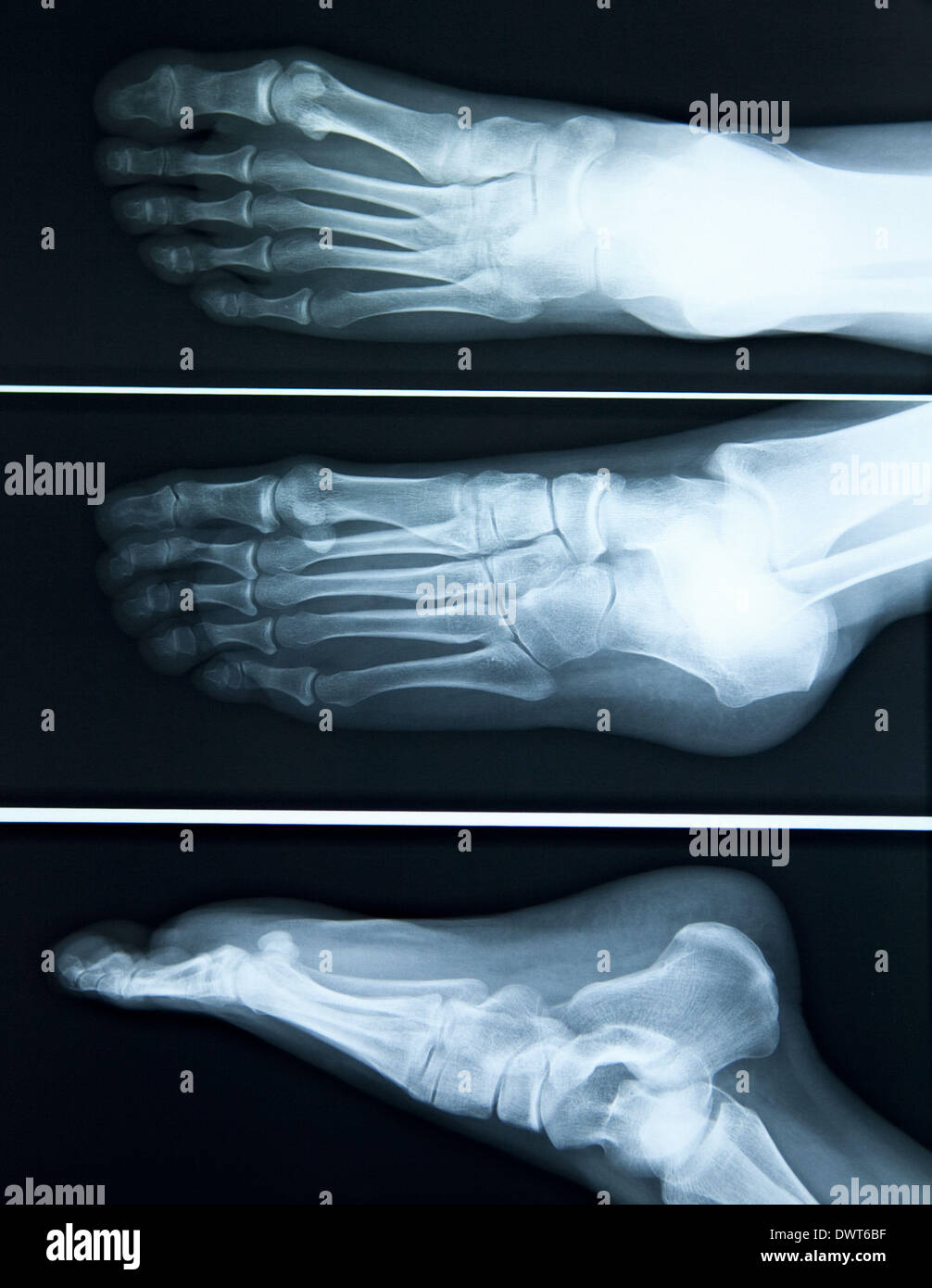 Flat foot x ray Stock Photo - Alamy